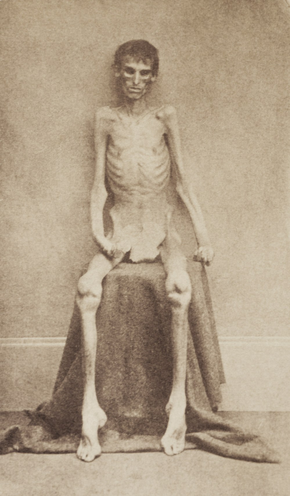 1865. This a picture of one of the survivors of Andersonville Prison. Union Army soldier on his release from Andersonville in May.jpg